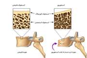 پوکی استخوان یا استئوپروز Osteoporosis 